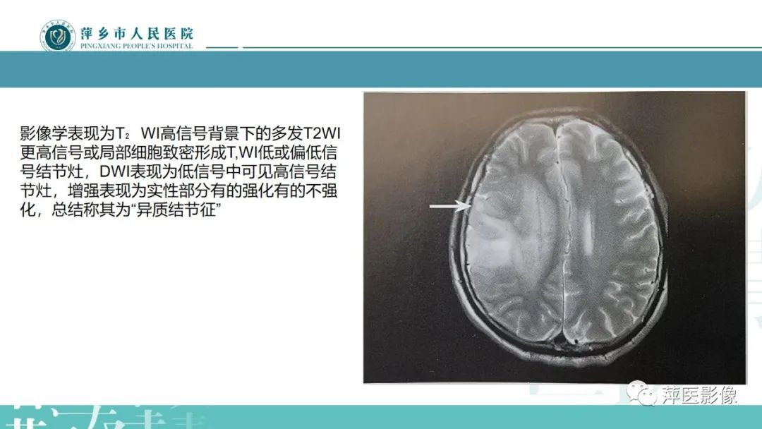 影像PPT - 【PPT】弥漫性胶质瘤MRI表现及鉴别诊断-18