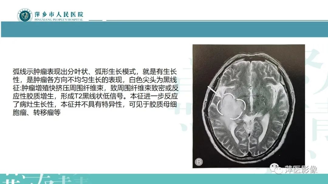 影像PPT - 【PPT】弥漫性胶质瘤MRI表现及鉴别诊断-16