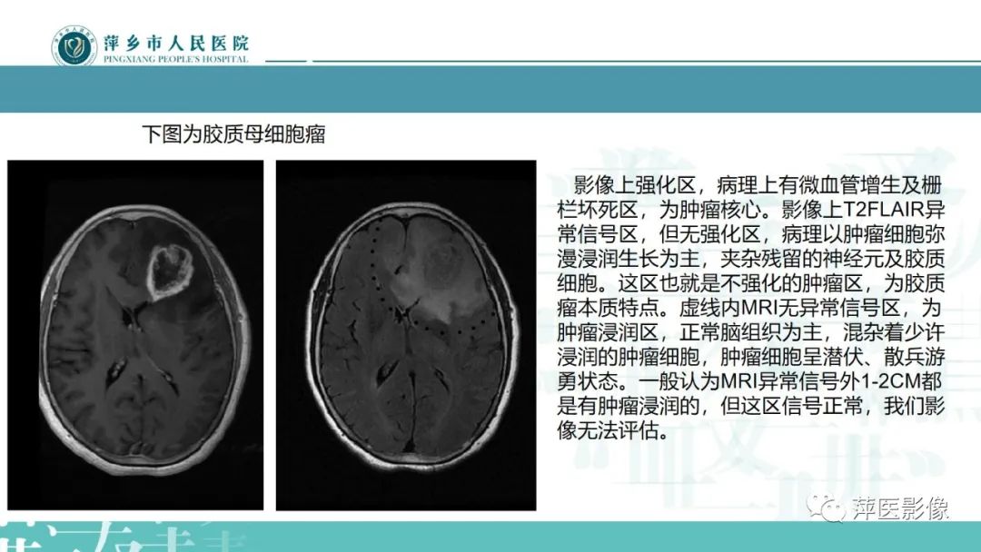 影像PPT - 【PPT】弥漫性胶质瘤MRI表现及鉴别诊断-19