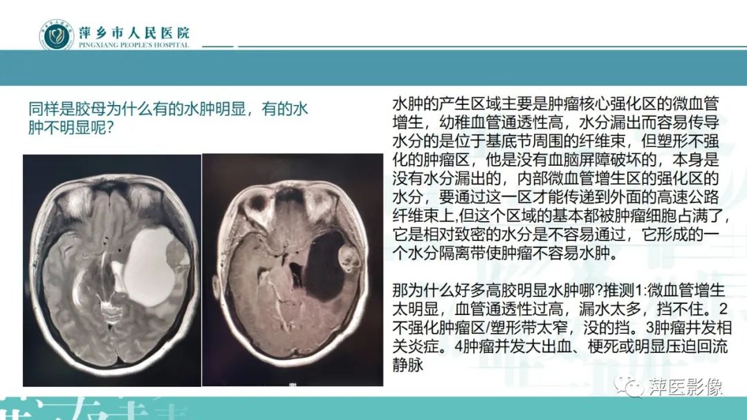 影像PPT - 【PPT】弥漫性胶质瘤MRI表现及鉴别诊断-20