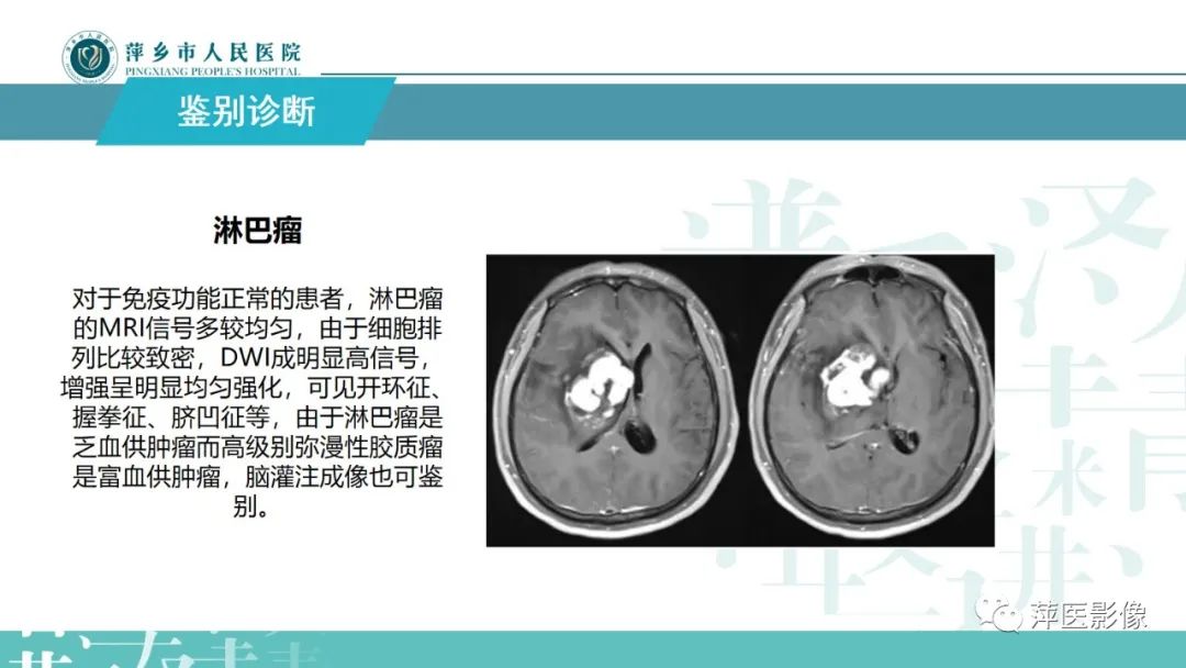 影像PPT - 【PPT】弥漫性胶质瘤MRI表现及鉴别诊断-23