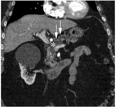 影像PPT - 胰腺炎性病变的影像征象识别-3 影像PPT - 胰腺炎性病变的影像征象识别-3