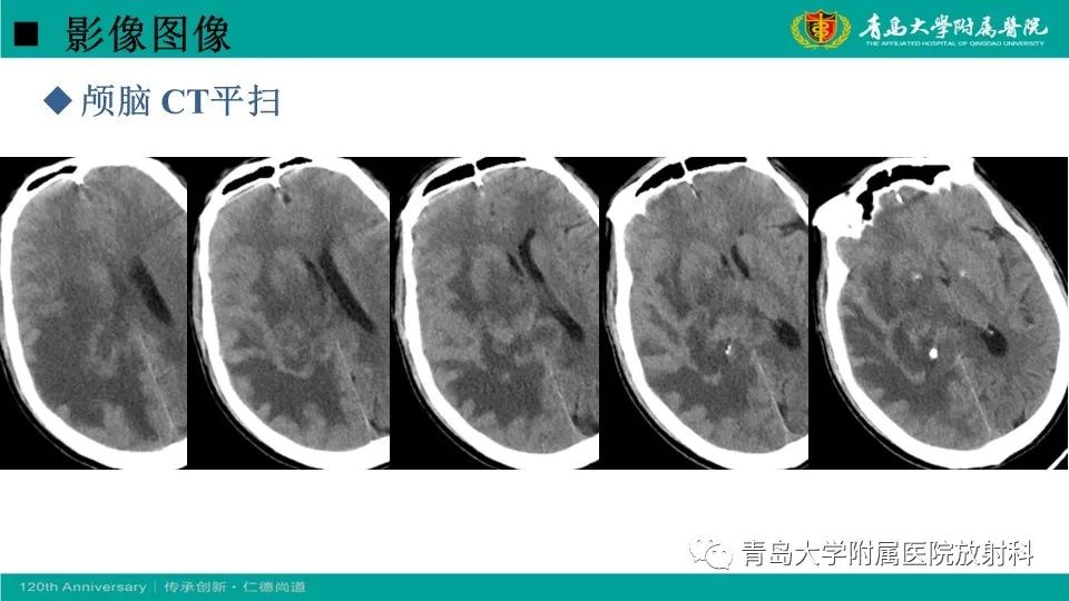 影像PPT - 【病例】原发性中枢神经系统淋巴瘤1例CT及MR影像-4