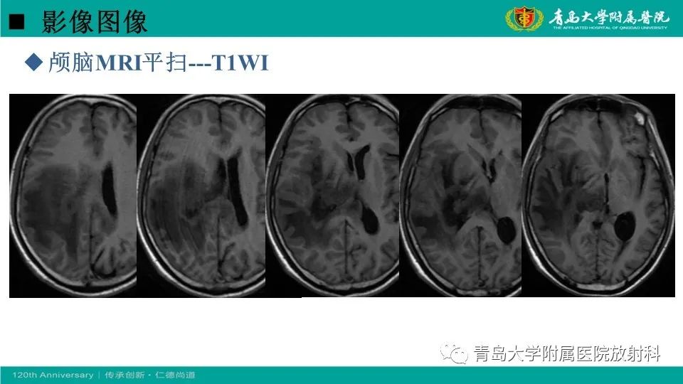 影像PPT - 【病例】原发性中枢神经系统淋巴瘤1例CT及MR影像-5