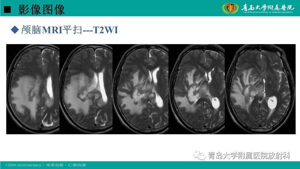 影像PPT - 【病例】原发性中枢神经系统淋巴瘤1例CT及MR影像-6