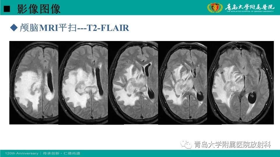 影像PPT - 【病例】原发性中枢神经系统淋巴瘤1例CT及MR影像-7