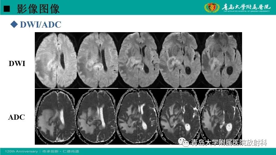 影像PPT - 【病例】原发性中枢神经系统淋巴瘤1例CT及MR影像-8