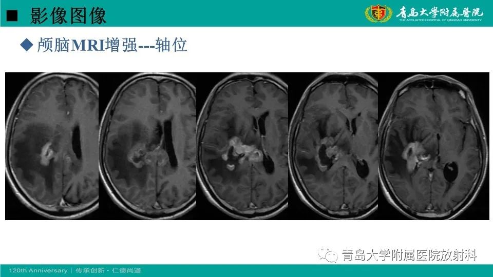 影像PPT - 【病例】原发性中枢神经系统淋巴瘤1例CT及MR影像-9