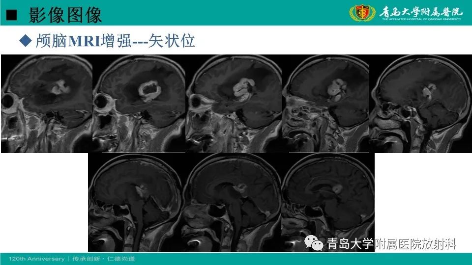 影像PPT - 【病例】原发性中枢神经系统淋巴瘤1例CT及MR影像-10