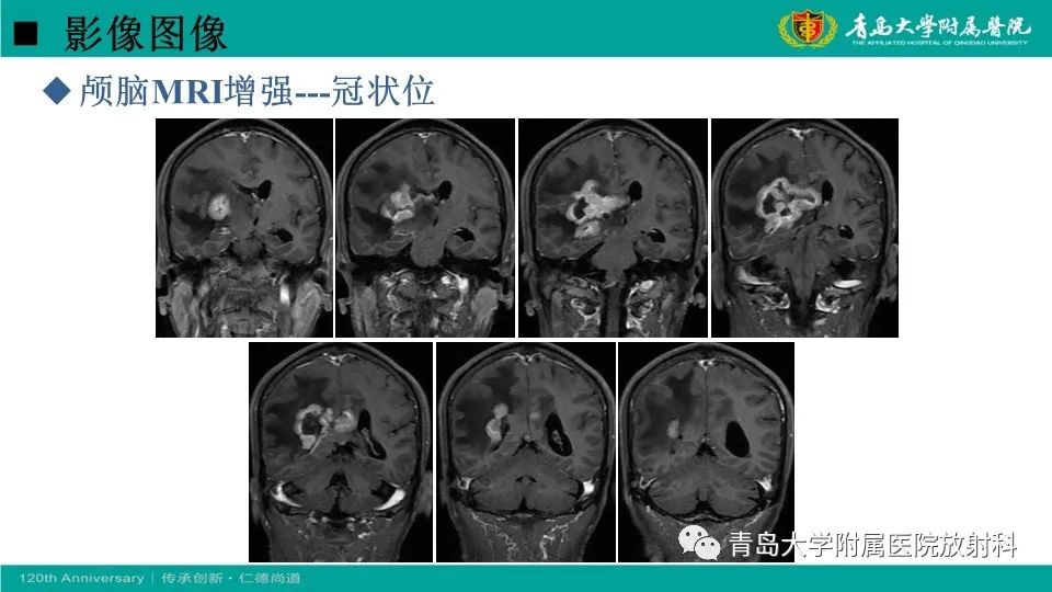 影像PPT - 【病例】原发性中枢神经系统淋巴瘤1例CT及MR影像-11
