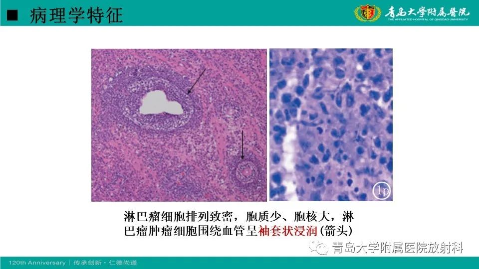 影像PPT - 【病例】原发性中枢神经系统淋巴瘤1例CT及MR影像-15
