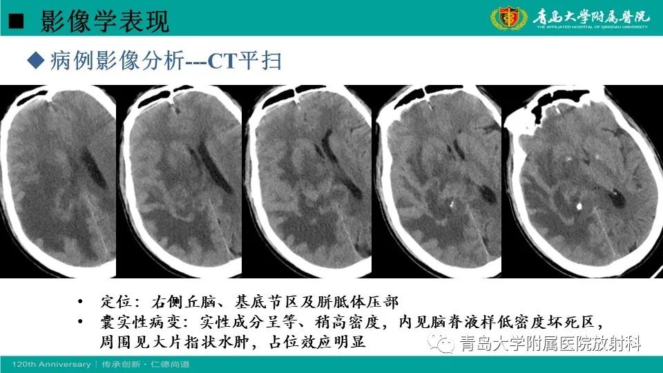 影像PPT - 【病例】原发性中枢神经系统淋巴瘤1例CT及MR影像-16