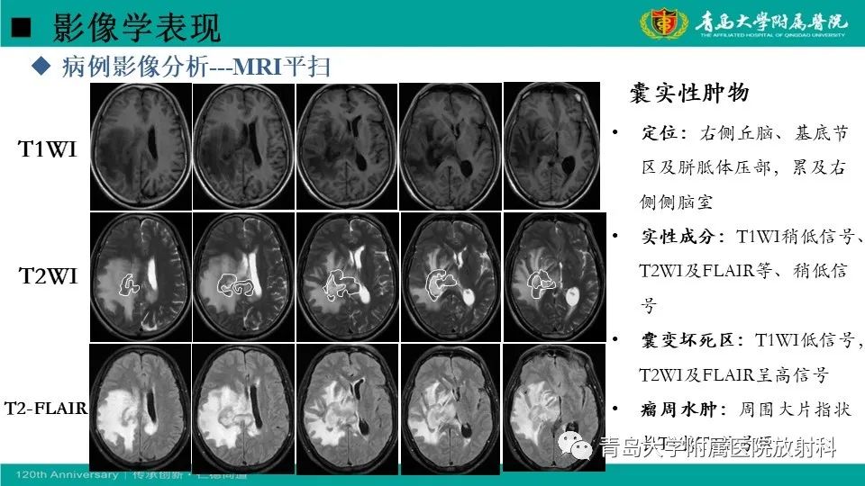 影像PPT - 【病例】原发性中枢神经系统淋巴瘤1例CT及MR影像-17