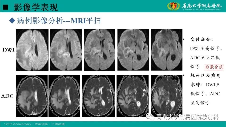 影像PPT - 【病例】原发性中枢神经系统淋巴瘤1例CT及MR影像-18