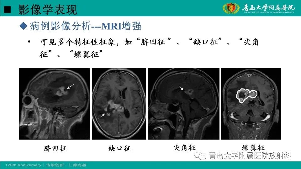 影像PPT - 【病例】原发性中枢神经系统淋巴瘤1例CT及MR影像-20
