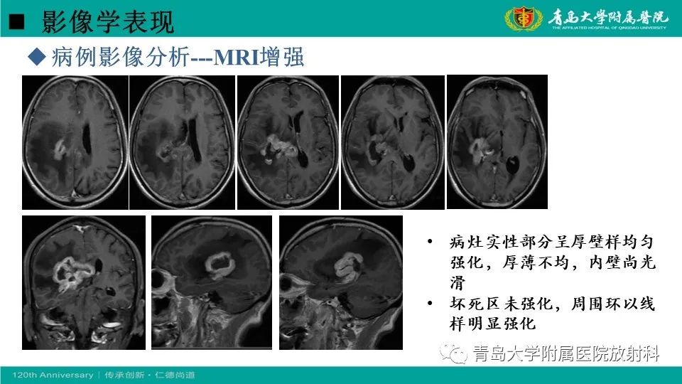 影像PPT - 【病例】原发性中枢神经系统淋巴瘤1例CT及MR影像-19