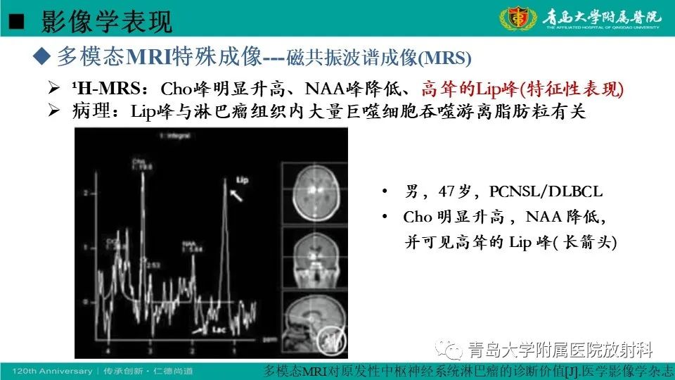 影像PPT - 【病例】原发性中枢神经系统淋巴瘤1例CT及MR影像-23
