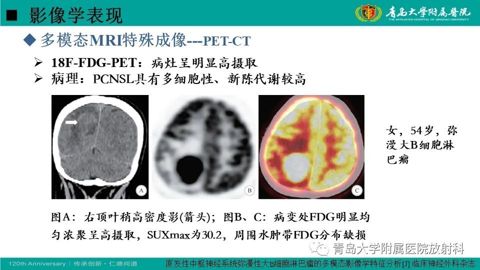 影像PPT - 【病例】原发性中枢神经系统淋巴瘤1例CT及MR影像-24