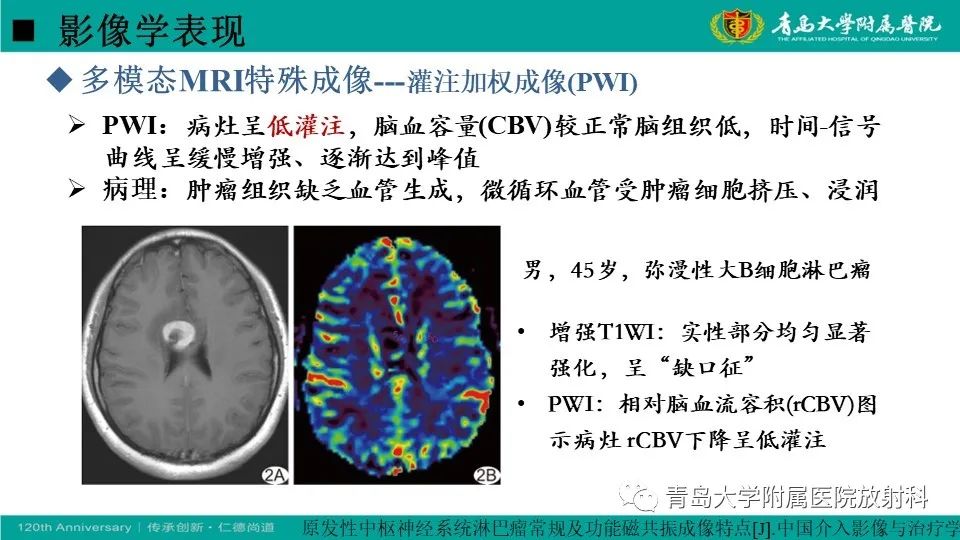 影像PPT - 【病例】原发性中枢神经系统淋巴瘤1例CT及MR影像-22