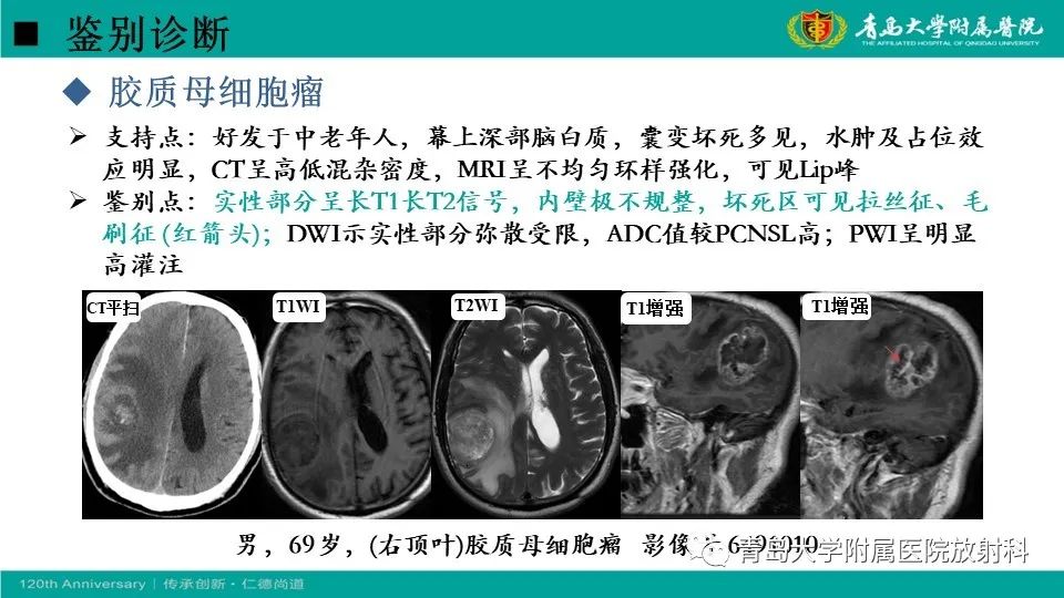 影像PPT - 【病例】原发性中枢神经系统淋巴瘤1例CT及MR影像-26