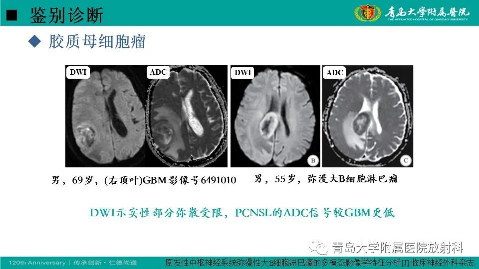 影像PPT - 【病例】原发性中枢神经系统淋巴瘤1例CT及MR影像-27