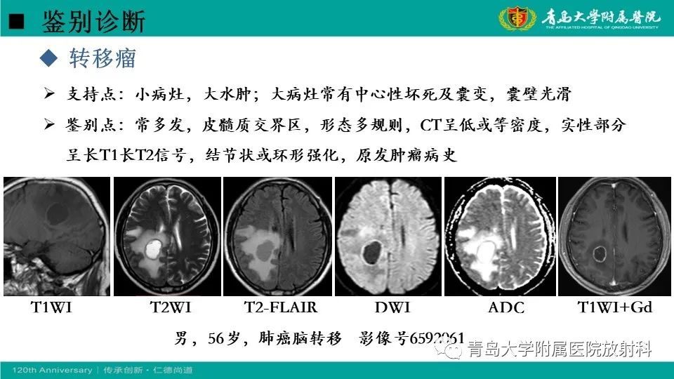 影像PPT - 【病例】原发性中枢神经系统淋巴瘤1例CT及MR影像-29