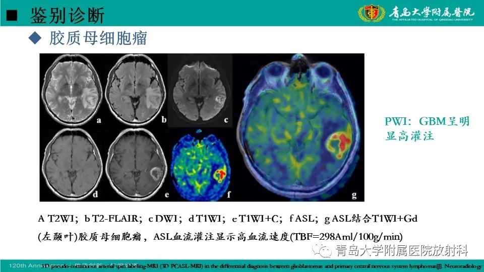 影像PPT - 【病例】原发性中枢神经系统淋巴瘤1例CT及MR影像-28