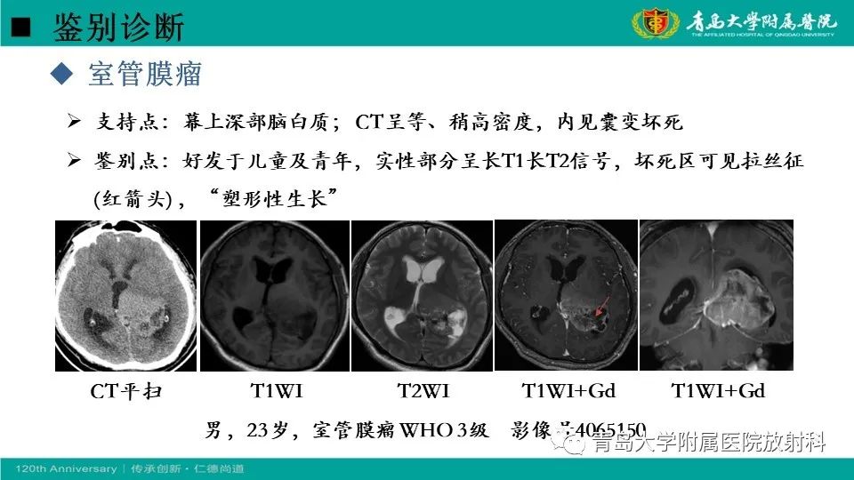 影像PPT - 【病例】原发性中枢神经系统淋巴瘤1例CT及MR影像-30