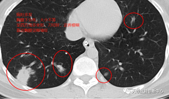 影像PPT - 【病例】肺非结核分枝杆菌(NTM-PD)一例CT影像-4 影像PPT - 【病例】肺非结核分枝杆菌(NTM-PD)一例CT影像-4