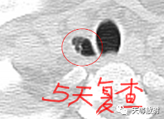 影像PPT - 【病例】气管憩室1例CT影像-2 影像PPT - 【病例】气管憩室1例CT影像-2