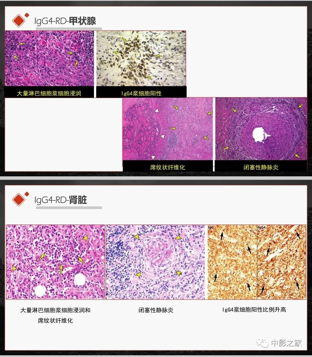 影像PPT - 【PPT】肾脏IgG4-RD临床、病理及影像特征-7