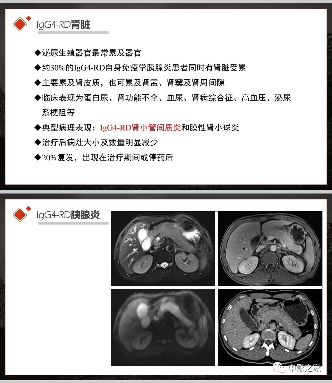 影像PPT - 【PPT】肾脏IgG4-RD临床、病理及影像特征-9