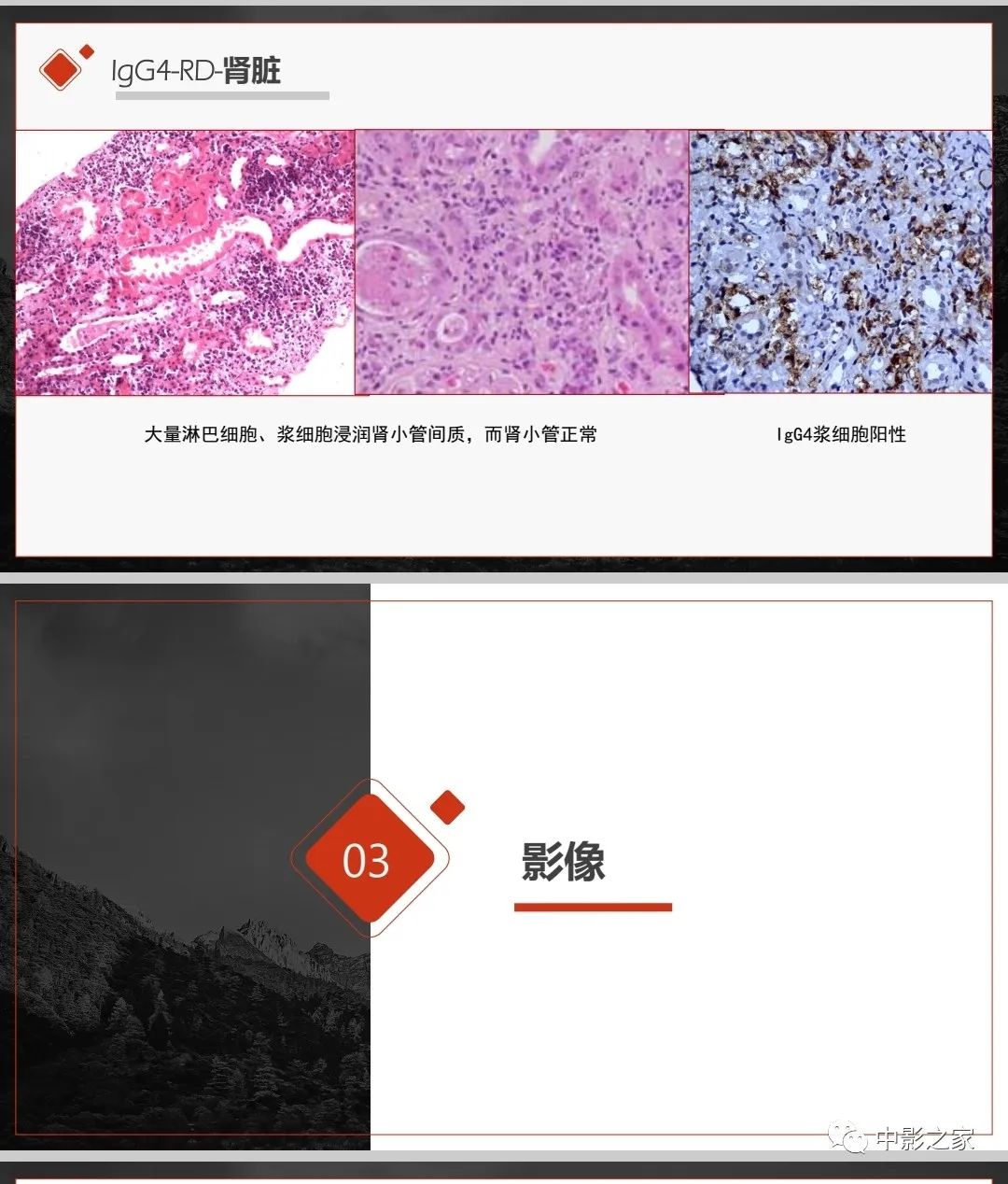 影像PPT - 【PPT】肾脏IgG4-RD临床、病理及影像特征-8