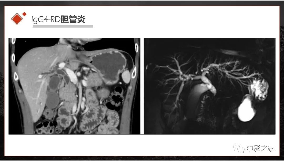 影像PPT - 【PPT】肾脏IgG4-RD临床、病理及影像特征-11