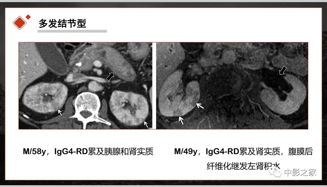 影像PPT - 【PPT】肾脏IgG4-RD临床、病理及影像特征-16