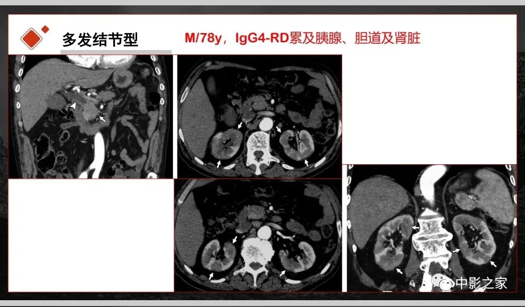 影像PPT - 【PPT】肾脏IgG4-RD临床、病理及影像特征-17