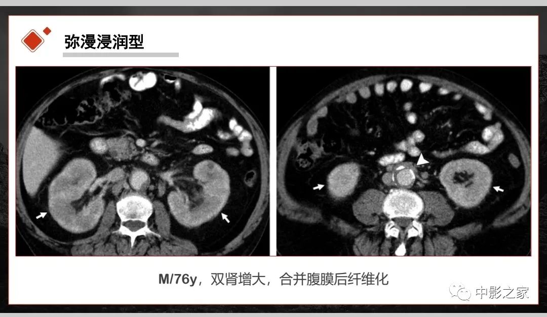 影像PPT - 【PPT】肾脏IgG4-RD临床、病理及影像特征-19