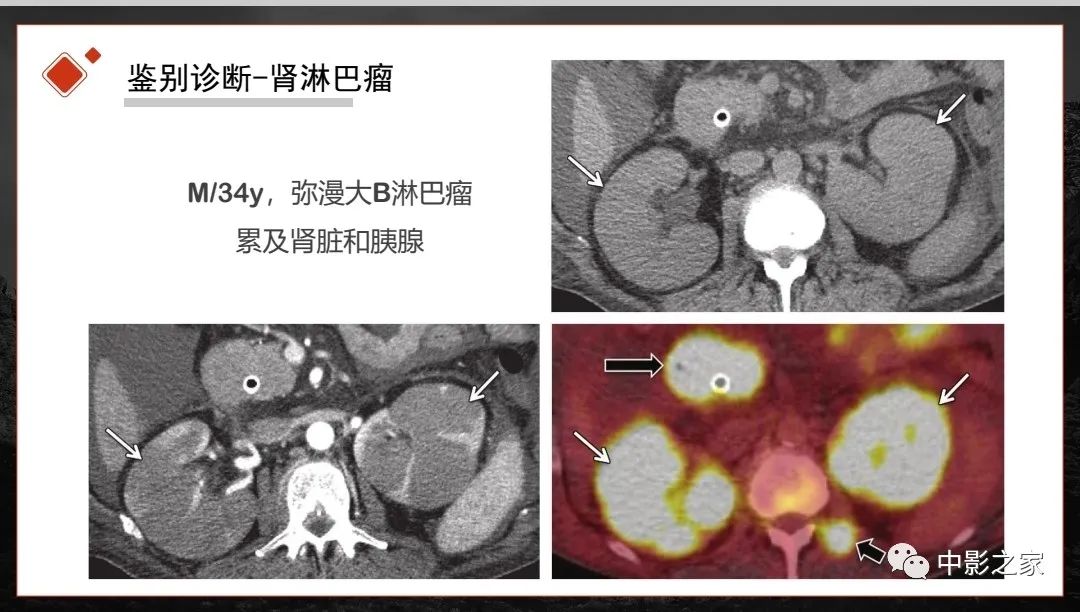 影像PPT - 【PPT】肾脏IgG4-RD临床、病理及影像特征-24