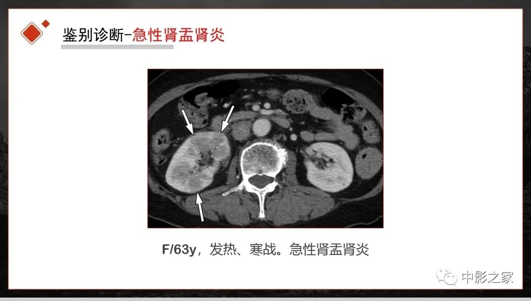 影像PPT - 【PPT】肾脏IgG4-RD临床、病理及影像特征-26