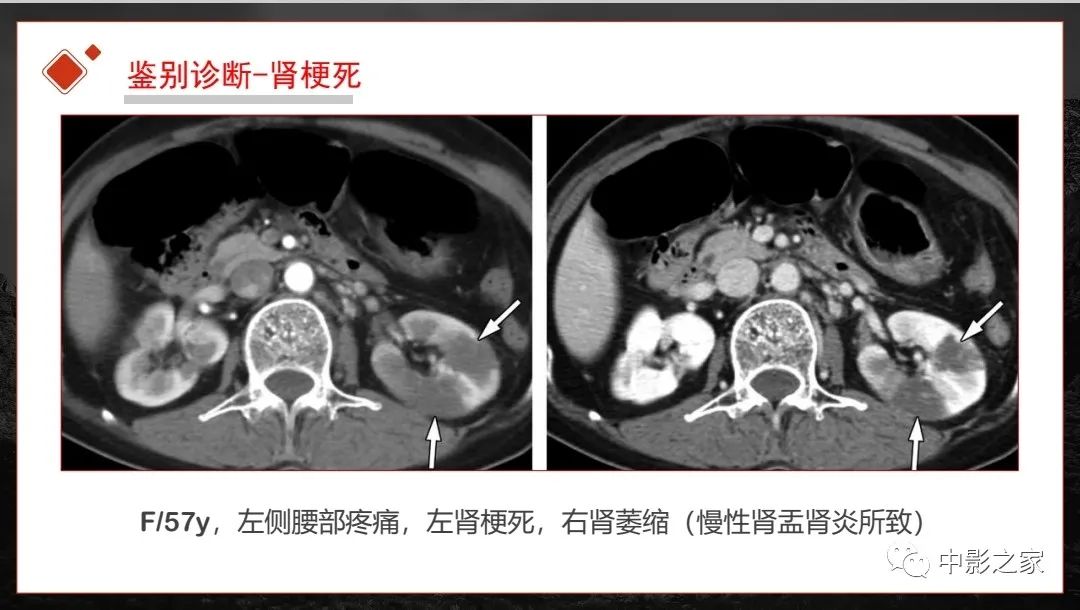 影像PPT - 【PPT】肾脏IgG4-RD临床、病理及影像特征-27