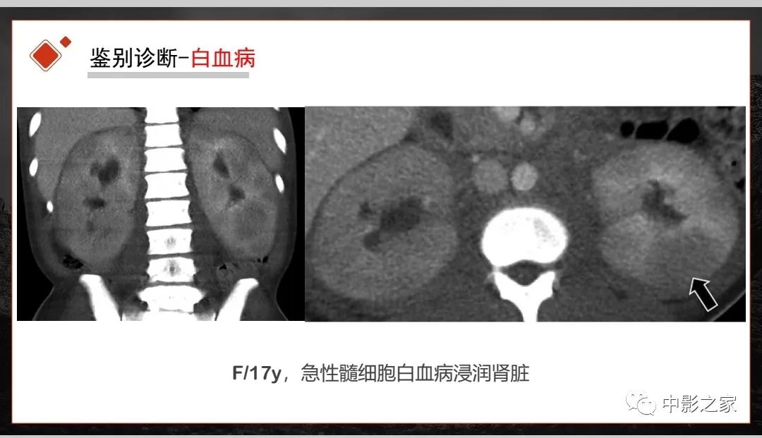 影像PPT - 【PPT】肾脏IgG4-RD临床、病理及影像特征-28