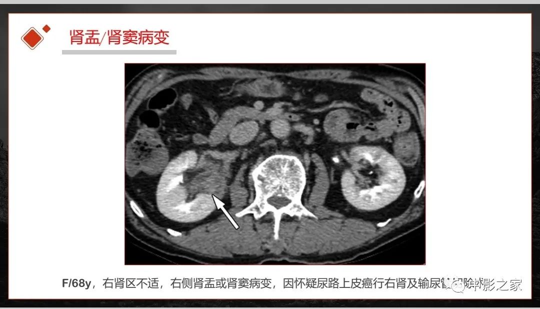 影像PPT - 【PPT】肾脏IgG4-RD临床、病理及影像特征-30