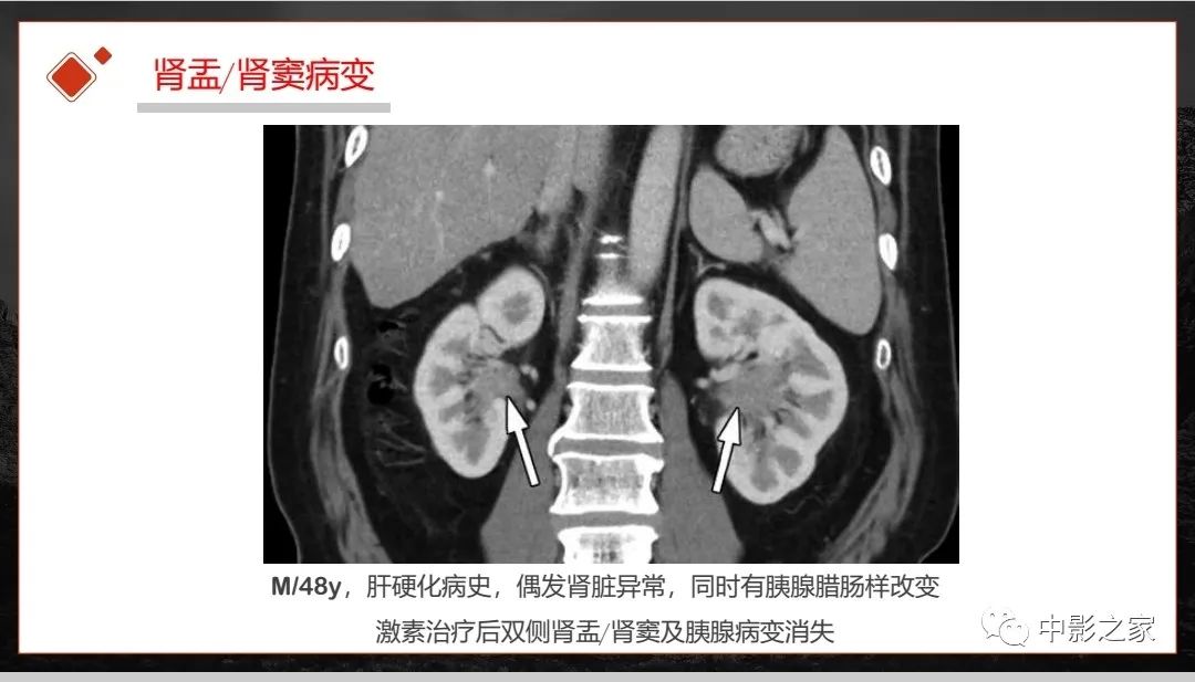 影像PPT - 【PPT】肾脏IgG4-RD临床、病理及影像特征-31