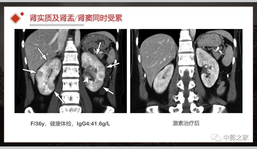 影像PPT - 【PPT】肾脏IgG4-RD临床、病理及影像特征-32