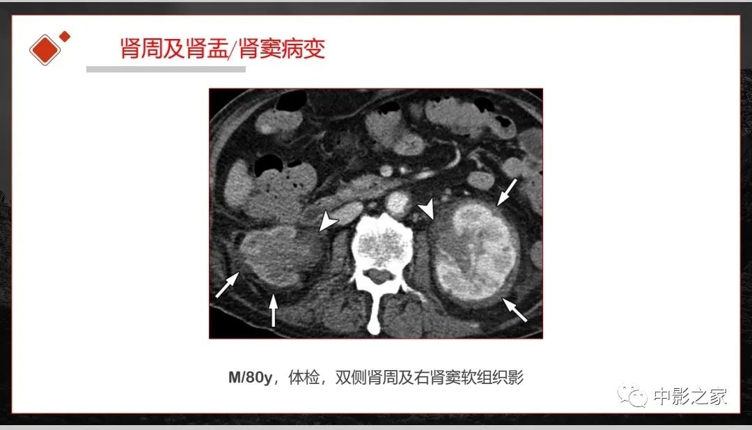 影像PPT - 【PPT】肾脏IgG4-RD临床、病理及影像特征-33