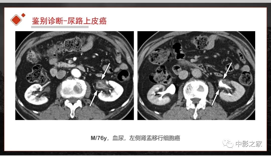 影像PPT - 【PPT】肾脏IgG4-RD临床、病理及影像特征-36