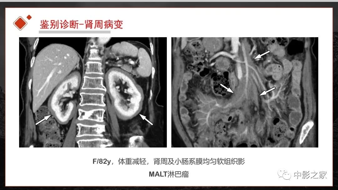 影像PPT - 【PPT】肾脏IgG4-RD临床、病理及影像特征-37