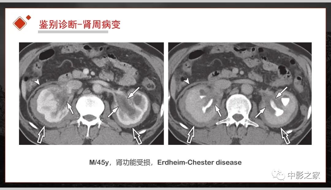 影像PPT - 【PPT】肾脏IgG4-RD临床、病理及影像特征-38