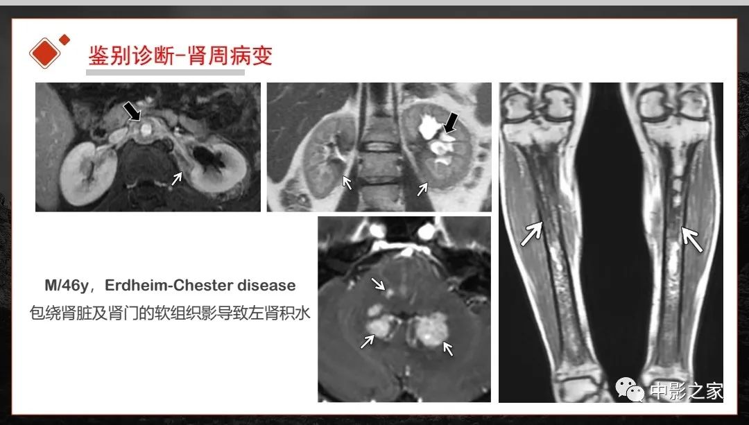 影像PPT - 【PPT】肾脏IgG4-RD临床、病理及影像特征-39