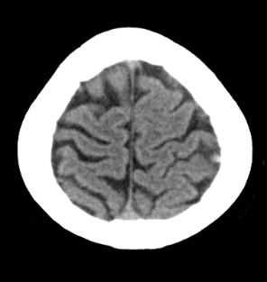 影像PPT - 【病例】静脉血栓形成伴梗死/出血2例CT及MR-4 影像PPT - 【病例】静脉血栓形成伴梗死/出血2例CT及MR-4